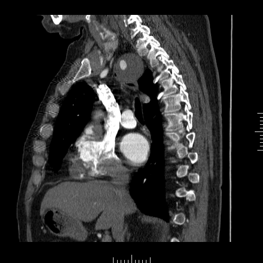 File:Aorto-coronary bypass graft aneurysms (Radiopaedia 40562-43157 C 13).png