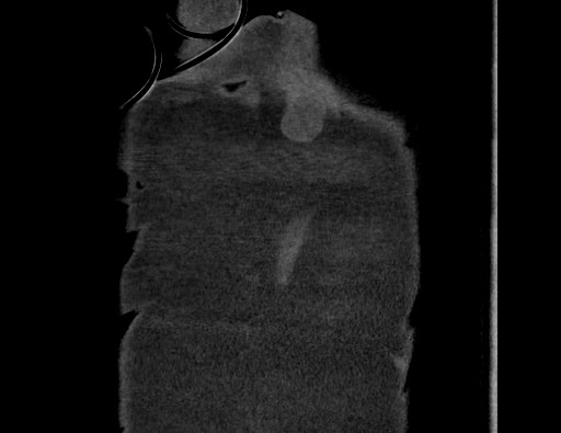 Aortoesophageal fistula with endovascular repair (Radiopaedia 73781-84592 Coronal C+ CTPA 144).jpg