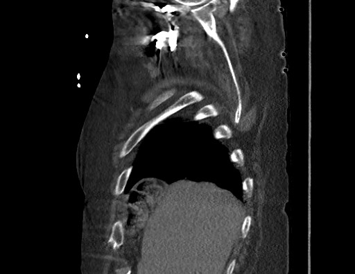 File:Aortoesophageal fistula with endovascular repair (Radiopaedia 73781-84592 Sagittal C+ CTPA 17).jpg
