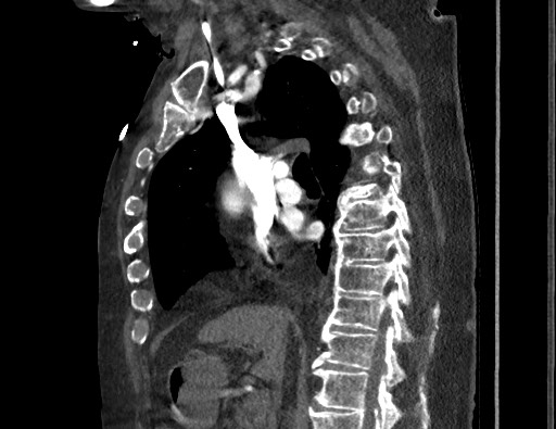 Aortoesophageal fistula with endovascular repair (Radiopaedia 73781-84592 Sagittal C+ CTPA 84).jpg