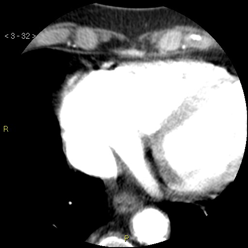 Aortoiliac occlusive disease (Radiopaedia 16828-16548 A 32).jpg