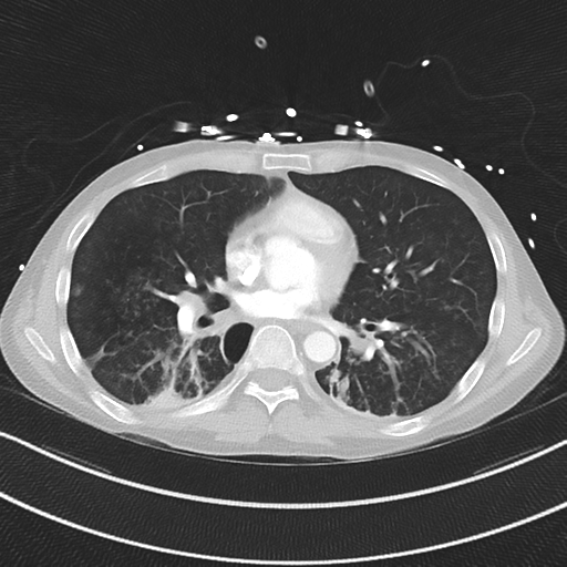 Apical bullous disease in a heavy smoker (Radiopaedia 33067-34092 Axial lung window 37).png