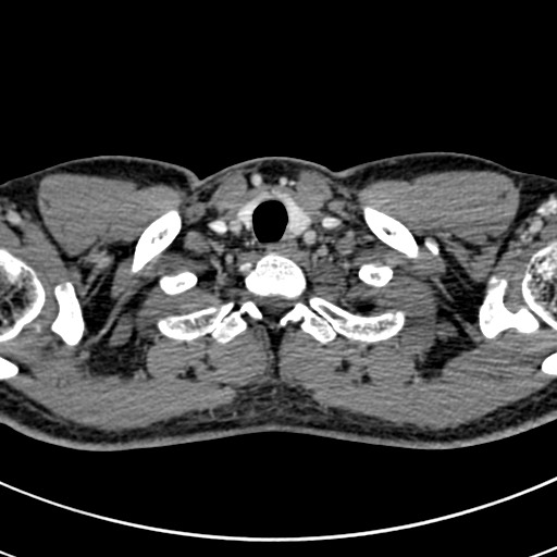 Apical lung mass mimic - neurogenic tumor (Radiopaedia 59918-67521 A 4).jpg