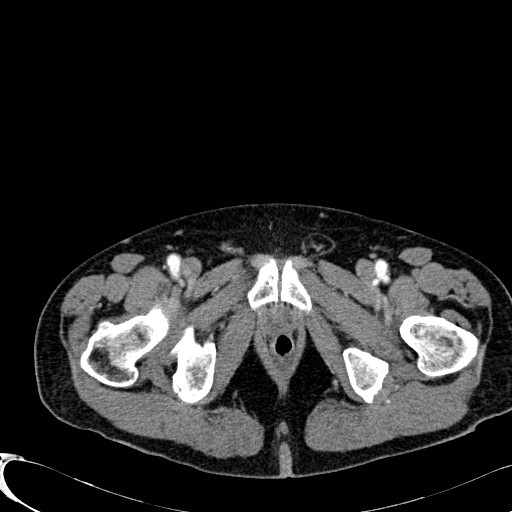 Appendiceal adenocarcinoma complicated by retroperitoneal abscess (Radiopaedia 58007-65039 B 146).jpg