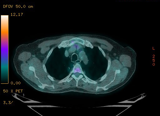 Appendiceal adenocarcinoma complicated by retroperitoneal abscess (Radiopaedia 58007-65041 Axial PET-CT 45).jpg