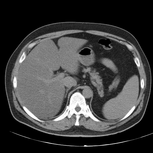 File:Appendicitis and giant appendicolith (Radiopaedia 80251-93588 Axial non-contrast 9).jpg