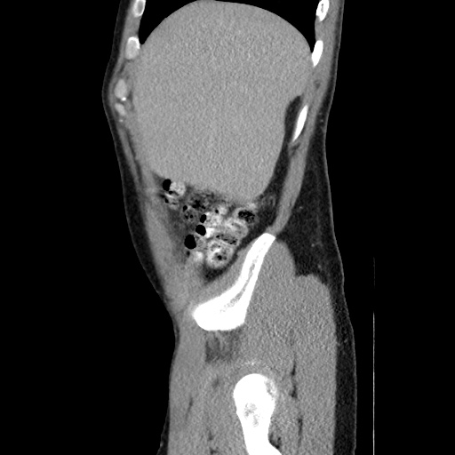 Appendicitis complicated by post-operative collection (Radiopaedia 35595-37114 C 17).jpg