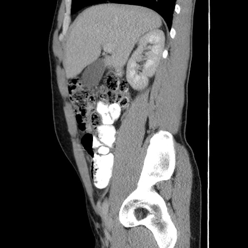 Appendicitis complicated by post-operative collection (Radiopaedia 35595-37114 C 26).jpg