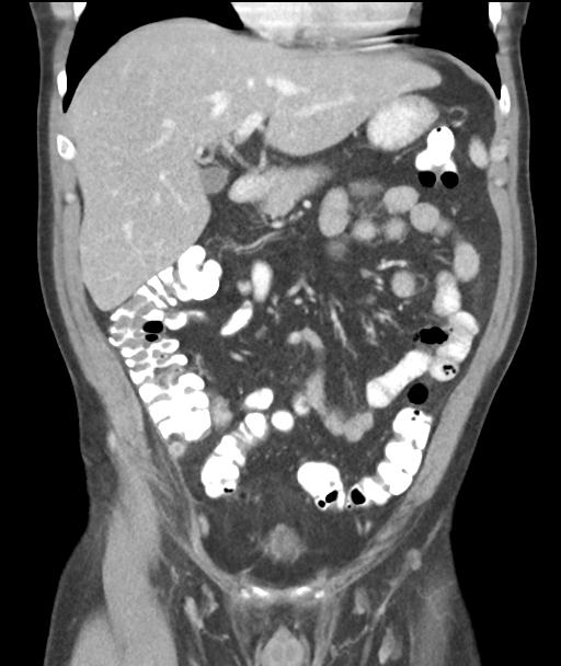 Appendicitis with cecal bar sign (Radiopaedia 31878-32830 A 25).jpg