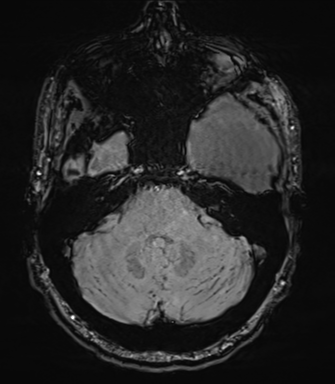 Arachnoid cyst with subdural hematoma (Radiopaedia 85892-101743 Axial SWI 18).png