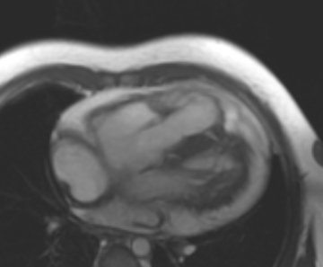 Arrhythmogenic right ventricular cardiomyopathy (Radiopaedia 69431-79307 4ch cine 63).jpg
