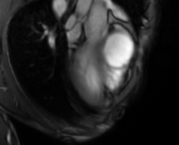File:Arrhythmogenic right ventricular cardiomyopathy (Radiopaedia 69564-79464 4ch cine 4).jpg