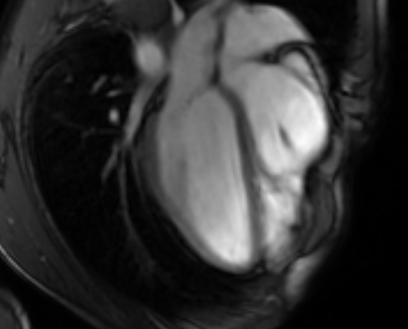 Arrhythmogenic right ventricular cardiomyopathy (Radiopaedia 69564-79464 4ch cine 62).jpg
