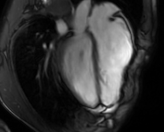 Arrhythmogenic right ventricular cardiomyopathy (Radiopaedia 69564-79464 4ch cine 99).jpg