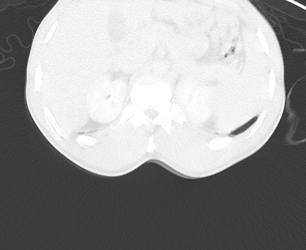 File:Arrow injury to the chest (Radiopaedia 75223-86321 Axial lung window 112).jpg