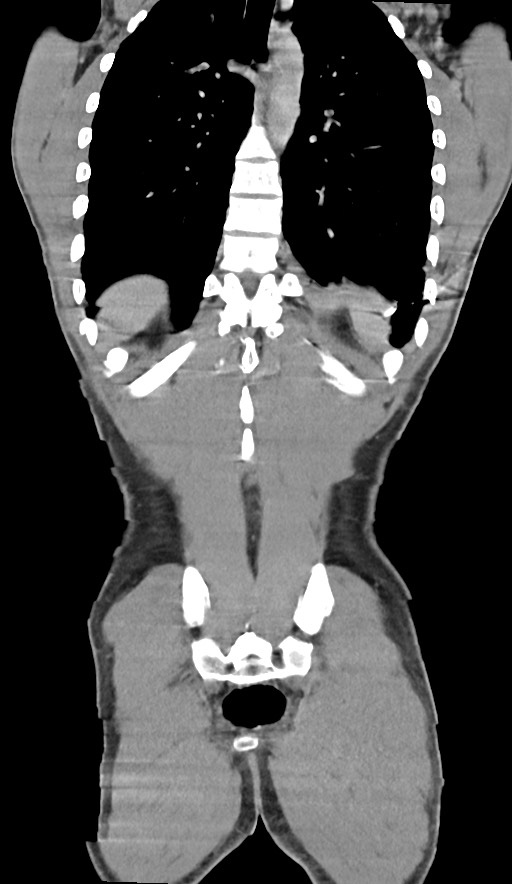 Arrow injury to the chest (Radiopaedia 75223-86321 E 73).jpg
