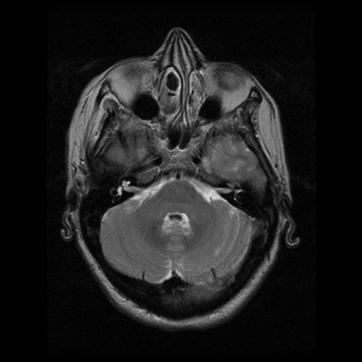 File:Arteriovenous malformation (cerebral) (Radiopaedia 40070-42580 Axial T2 7).png