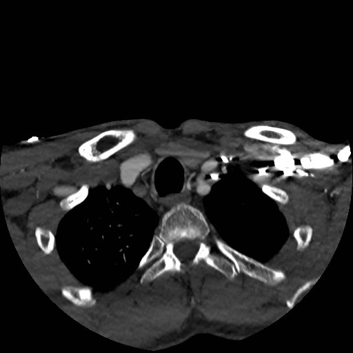 Artery of Percheron infarct (Radiopaedia 48088-52894 A 25).jpg
