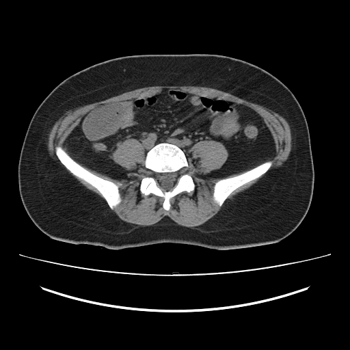 Ascending retrocecal appendicitis with liver abscesses (Radiopaedia 60066-67615 Axial non-contrast 57).jpg