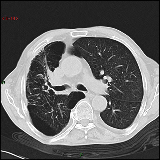 File:Aspergilloma (Radiopaedia 14842-14787 Axial lung window 19).jpg