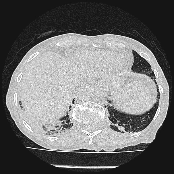 Aspergilloma (Radiopaedia 24458-24763 Axial lung window 59).jpg