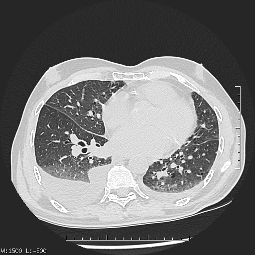 Aspergilloma (Radiopaedia 75184-86270 Axial lung window 32).jpg