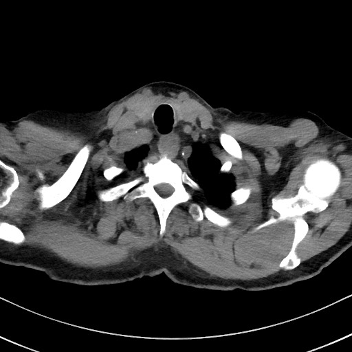 Aspergilloma on background pulmonary fibrosis (Radiopaedia 60942-68757 Axial non-contrast 5).jpg