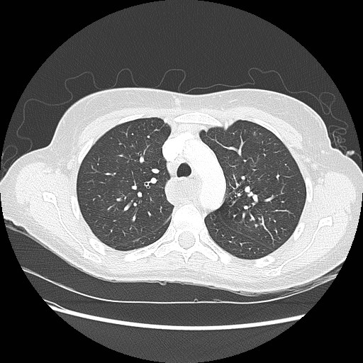 File:Aspiration pneumonia secondary to laparoscopic banding (Radiopaedia 18345-18183 lung window 31).jpg