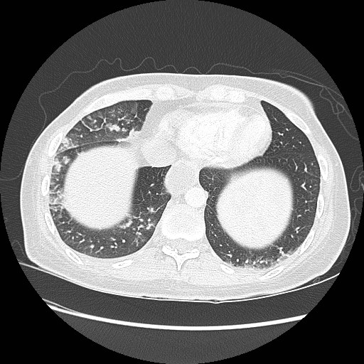 Aspiration pneumonia secondary to laparoscopic banding (Radiopaedia 18345-18183 lung window 89).jpg