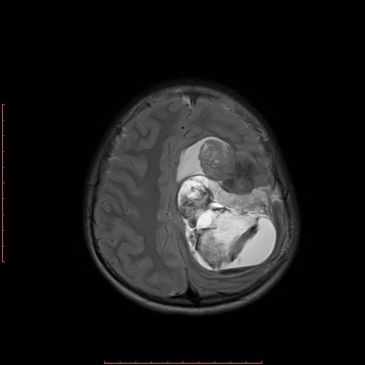 File:Astroblastoma (Radiopaedia 74287-85162 Axial T2 17).jpg