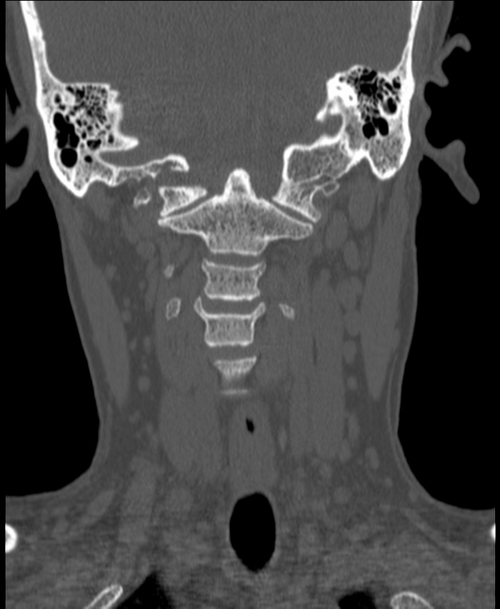 Atlanto-occipital assimilation with basilar invagination (Radiopaedia 70122-80188 Coronal bone window 82).jpg