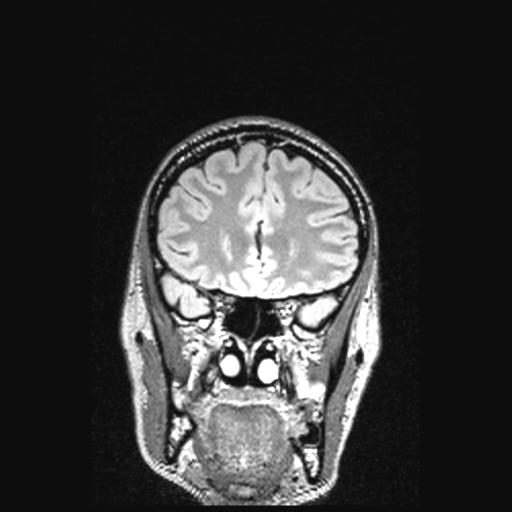 Atretic encephalocoele with inferior vermis hypoplasia (Radiopaedia 30443-31108 Coronal FLAIR 133).jpg