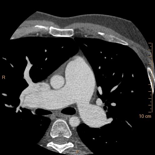 Atrial septal defect (upper sinus venosus type) with partial anomalous pulmonary venous return into superior vena cava (Radiopaedia 73228-83961 A 60).jpg