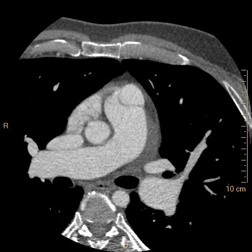 Atrial septal defect (upper sinus venosus type) with partial anomalous pulmonary venous return into superior vena cava (Radiopaedia 73228-83961 A 77).jpg