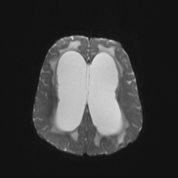 Atypical medulloblastoma (Radiopaedia 34903-36371 Axial DWI 20).jpg