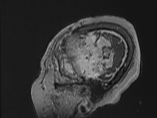Atypical meningioma (Radiopaedia 62985-71406 Sagittal T1 C+ 91).jpg