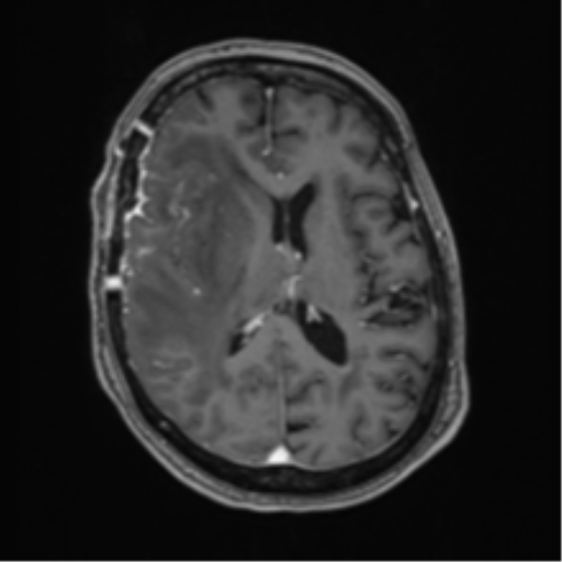 Atypical meningioma (WHO Grade II) (Radiopaedia 54742-60981 Axial T1 C+ 40).png