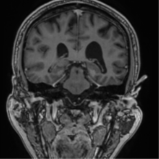 File:Atypical meningioma (WHO grade II) with brain invasion (Radiopaedia 57767-64729 Coronal T1 C+ 51).png
