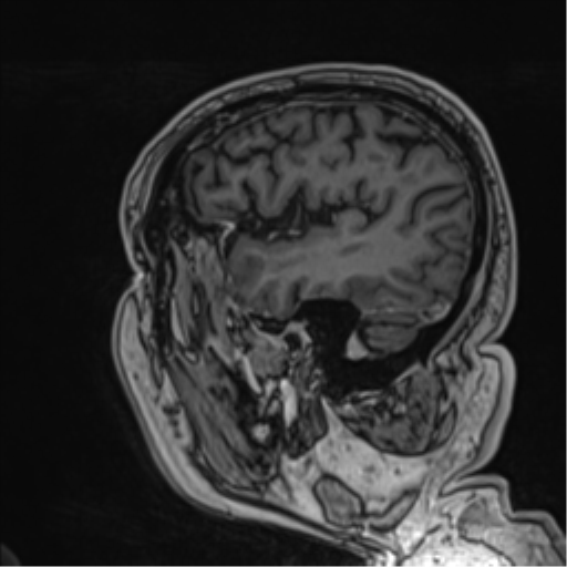 Atypical meningioma (WHO grade II) with brain invasion (Radiopaedia 57767-64729 Sagittal T1 C+ 20).png