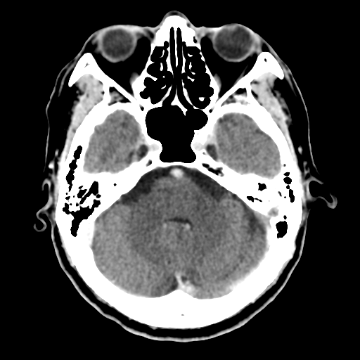 File:Atypical meningioma (WHO grade II) with osseous invasion (Radiopaedia 53654-59715 Axial C+ delayed 16).png