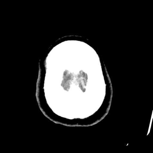 File:Atypical meningioma (WHO grade II) with osseous invasion (Radiopaedia 53654-59715 Axial C+ delayed 49).png
