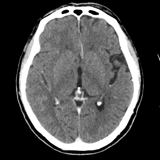 Atypical meningioma with skull invasion (Radiopaedia 34357-35649 Axial C+ delayed 27).png