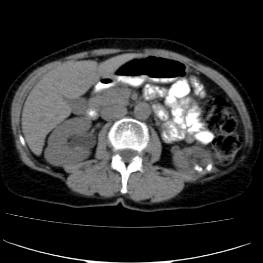 File:Atypical renal cyst (Radiopaedia 17536-17251 non-contrast 17).jpg