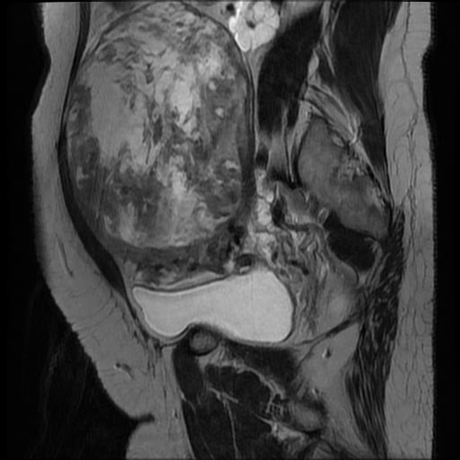 File:Atypical retroperitoneal lymphocoeles with large leiomyoma of uterus (Radiopaedia 32084-33027 Sagittal T2 10).jpg