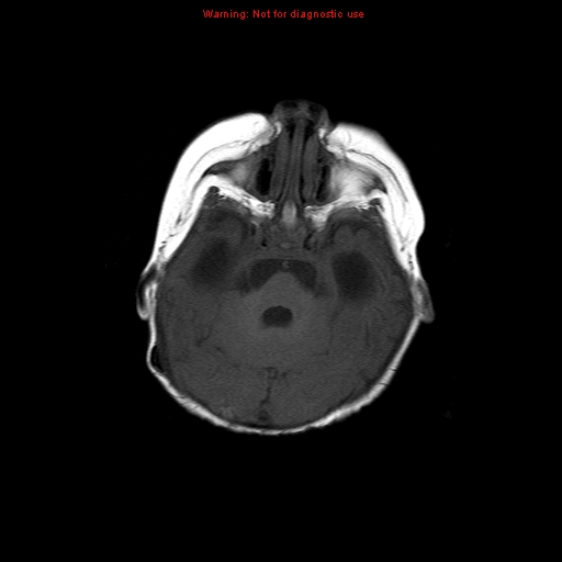 File:Atypical teratoid rhabdoid tumor (Radiopaedia 10712-11183 Axial T1 13).jpg