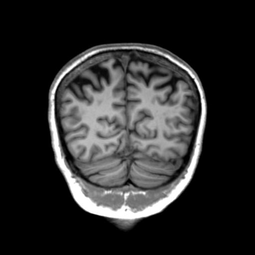 Autoimmune limbic encephalitis (Radiopaedia 30363-31005 Coronal T1 14).jpg