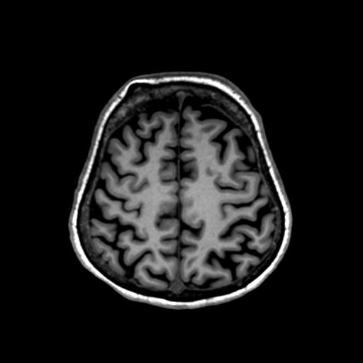 Autoimmune limbic encephalitis (Radiopaedia 30363-31005 T1 Axial 1mm 118).jpg