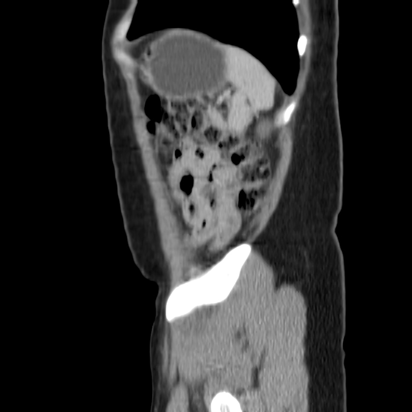 Autosomal dominant polycystic kidney disease (Radiopaedia 23061-23093 F 49).jpg