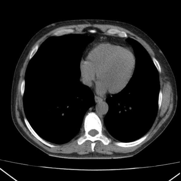 File:Autosomal dominant polycystic kidney disease (Radiopaedia 36539-38101 Axial non-contrast 2).jpg