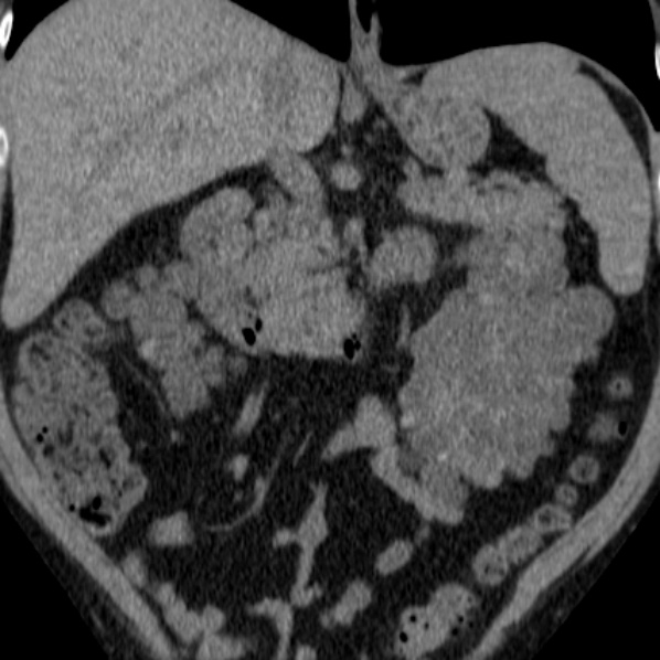 File:Autosomal dominant polycystic kidney disease (Radiopaedia 36539-38101 Coronal non-contrast 15).jpg